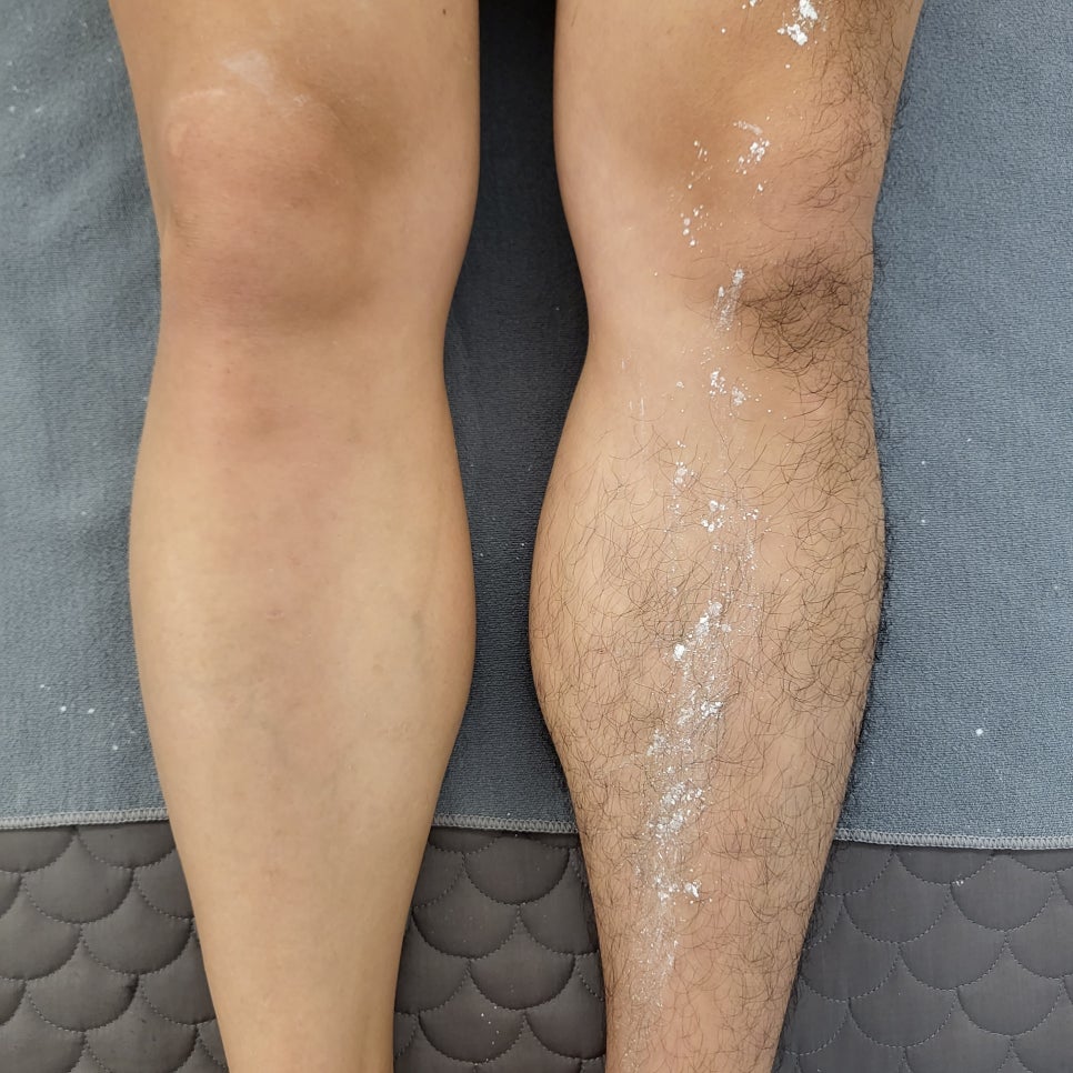 대전 괴정동 남자 다리전체 슈가왁싱 시술 전후 비교