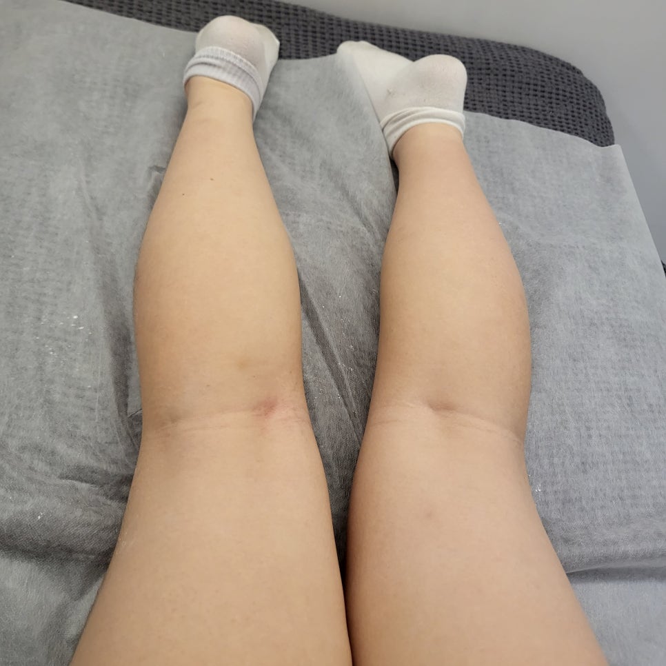 대전롯데점 다리전체 왁싱 후 두 다리 뒤쪽 모습