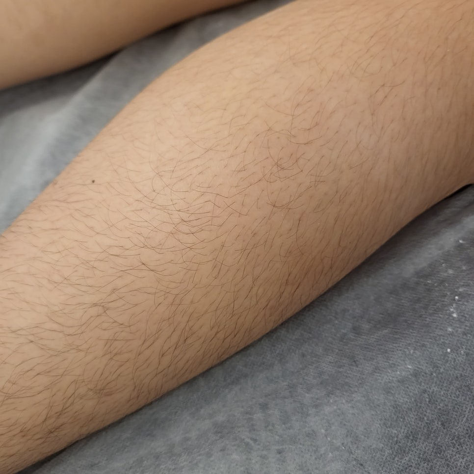 다리 슈가왁싱 전 뒤쪽에 자란 잔털을 가까이 촬영한 사진