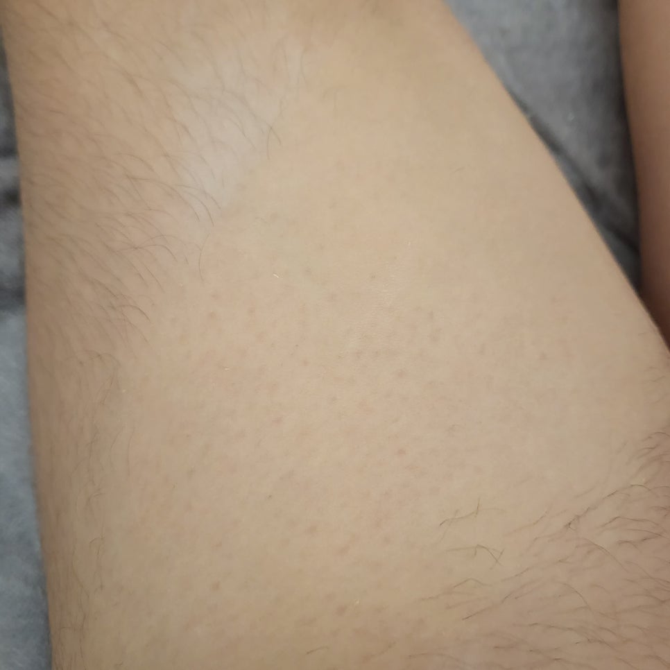 다리 슈가링 도중 가운데 털을 정리한 자리와 주변 잔털