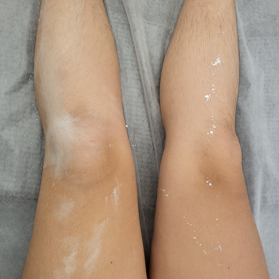 세븐데이즈 대전롯데점 다리왁싱 전 무릎 주변과 다리에 자란 털
